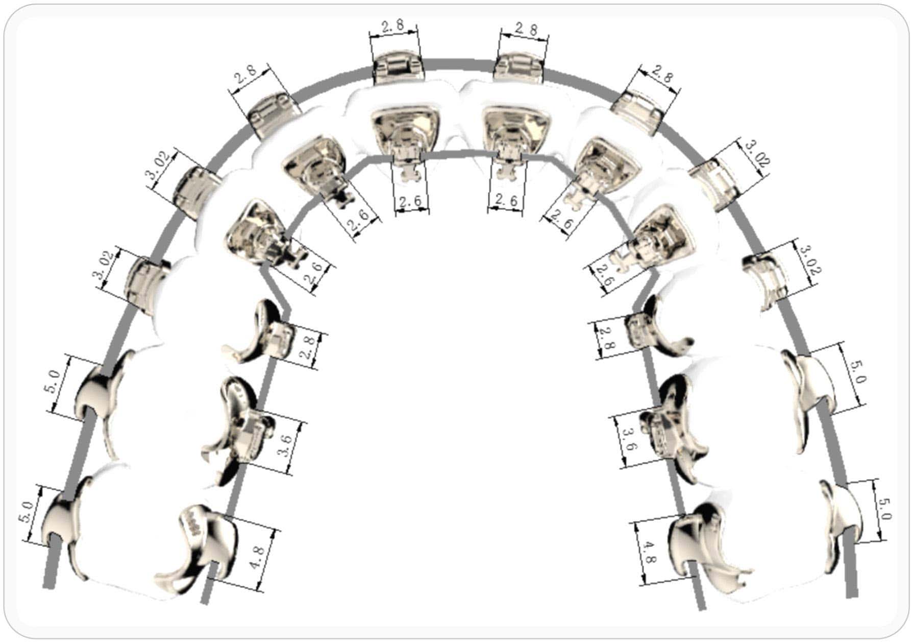 InBracket Customized Lingual Bracket System - FN Orthodontics