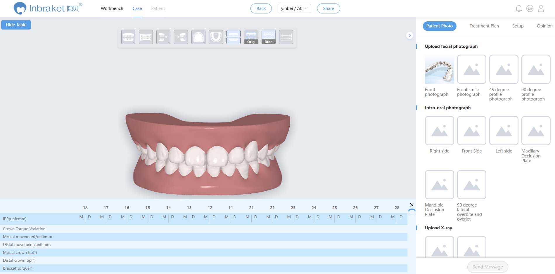 InBracket Customized Lingual Bracket System - FN Orthodontics