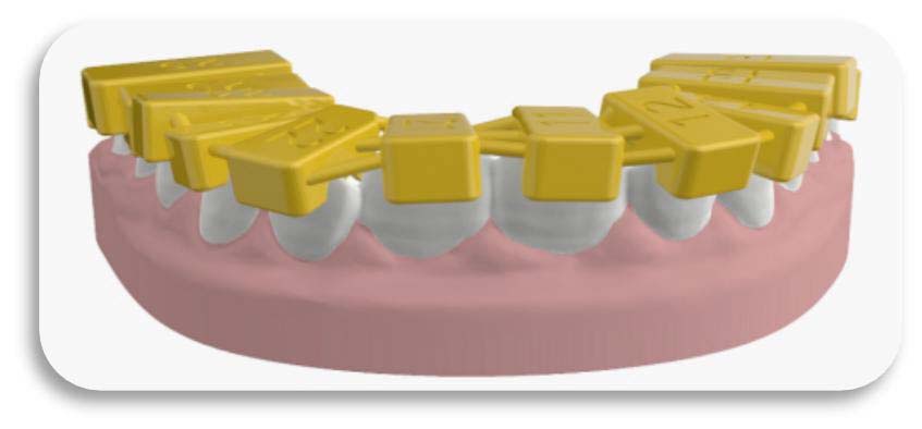 InBracket Customized Lingual Bracket System - FN Orthodontics