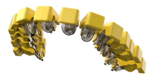 InBracket Customized Lingual Bracket System - FN Orthodontics
